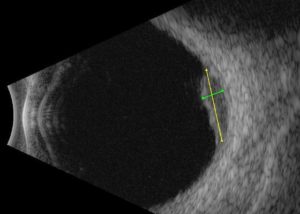 Ecografia bulbare B-scan