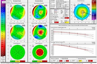 screening cheratocono