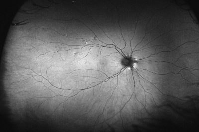 Autofluorescenza retinica ultra-widefield